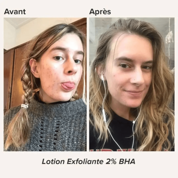 work-16.png PAULA'S CHOICE salicylic skin perfecting 2 bha liquid exfoliant 30ml – Image 5